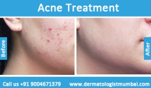 acne-treatment-before-after-photos-in-mumbai-india-1