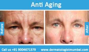 anti-aging-treatment-before-after-photos-in-mumbai-india-6