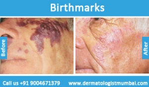birthmarks-removal-treatment-before-after-photos-in-mumbai-india-1