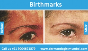 birthmarks-removal-treatment-before-after-photos-in-mumbai-india-4