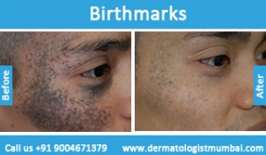birthmarks-removal-treatment-before-after-photos-in-mumbai-india-5