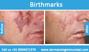 birthmarks-removal-treatment-before-after-photos-in-mumbai-india-6