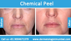 chemical-skin-peeling-treatment-before-after-photos-in-mumbai-india-1