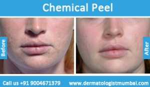 chemical-skin-peeling-treatment-before-after-photos-in-mumbai-india-3