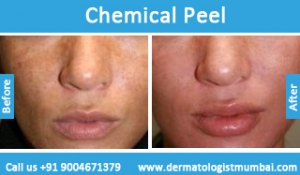 chemical-skin-peeling-treatment-before-after-photos-in-mumbai-india-5