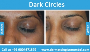 dark-circles-treatment-before-after-photos-in-mumbai-india-2