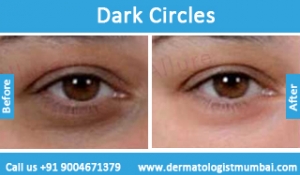 dark-circles-treatment-before-after-photos-in-mumbai-india-3