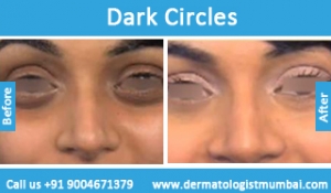dark-circles-treatment-before-after-photos-in-mumbai-india-4