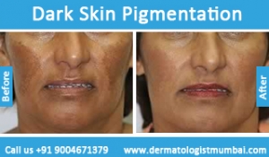 dark-skin-pigmentation-treatment-before-after-photos-in-mumbai-india-5