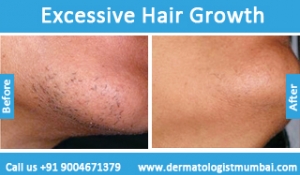 excessive-hair-growth-treatment-before-after-photos-in-mumbai-india-2