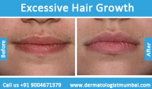 excessive-hair-growth-treatment-before-after-photos-in-mumbai-india-4