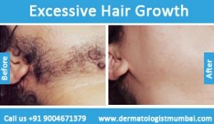 excessive-hair-growth-treatment-before-after-photos-in-mumbai-india-5