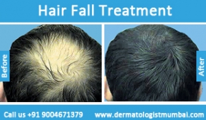 hair-loss-treatment-before-after-photos-in-mumbai-india-2