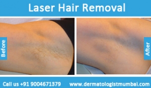 laser-hair-removal-treatment-before-after-photos-in-mumbai-india-3
