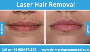 laser-hair-removal-treatment-before-after-photos-in-mumbai-india-4