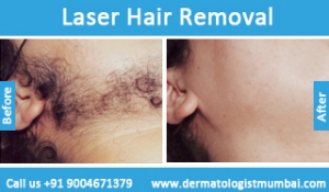 laser-hair-removal-treatment-before-after-photos-in-mumbai-india-5