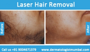 laser-hair-removal-treatment-before-after-photos-in-mumbai-india-6