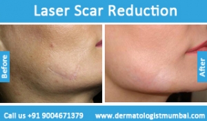laser-scar-reduction-treatment-before-after-photos-in-mumbai-india-3