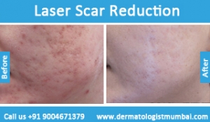 laser-scar-reduction-treatment-before-after-photos-in-mumbai-india-4
