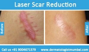 laser-scar-reduction-treatment-before-after-photos-in-mumbai-india-5
