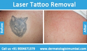 laser-tattoo-removal-treatment-before-after-photos-in-mumbai-india-2