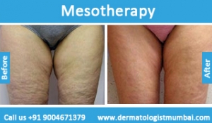 mesotherapy-treatment-before-after-photos-in-mumbai-india-4