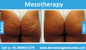 mesotherapy-treatment-before-after-photos-in-mumbai-india-6