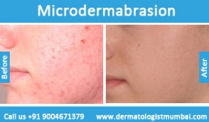 microdermabrasion-treatment-before-after-photos-in-mumbai-india-3