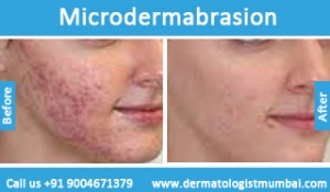 microdermabrasion-treatment-before-after-photos-in-mumbai-india-6