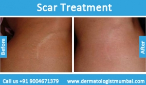 scars-removal-treatment-before-after-photos-in-mumbai-india-1