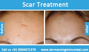 scars-removal-treatment-before-after-photos-in-mumbai-india-2