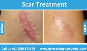 scars-removal-treatment-before-after-photos-in-mumbai-india-6