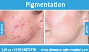 skin-pigmentation-treatment-before-after-photos-in-mumbai-india-5