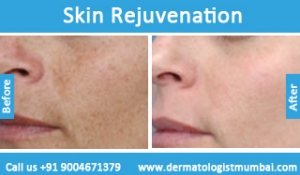 skin-rejuvenation-treatment-before-after-photos-in-mumbai-india-1