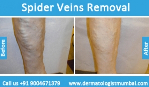 spider-veins-removal-treatment-before-after-photos-in-mumbai-india-2