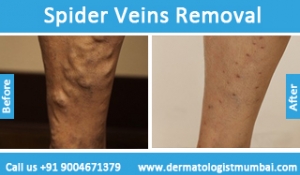 spider-veins-removal-treatment-before-after-photos-in-mumbai-india-4