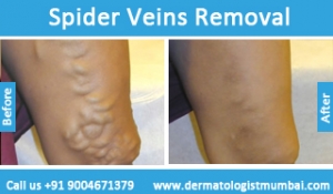 spider-veins-removal-treatment-before-after-photos-in-mumbai-india-6