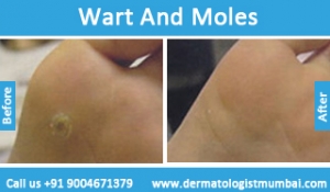 warts-and-moles-removal-treatment-before-after-photos-in-mumbai-india-1