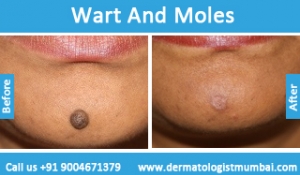warts-and-moles-removal-treatment-before-after-photos-in-mumbai-india-2
