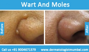 warts-and-moles-removal-treatment-before-after-photos-in-mumbai-india-3