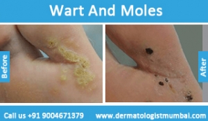 warts-and-moles-removal-treatment-before-after-photos-in-mumbai-india-4