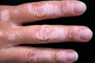 Vitiligo Treatment, Leukoderma, White Spots Removal Treatment