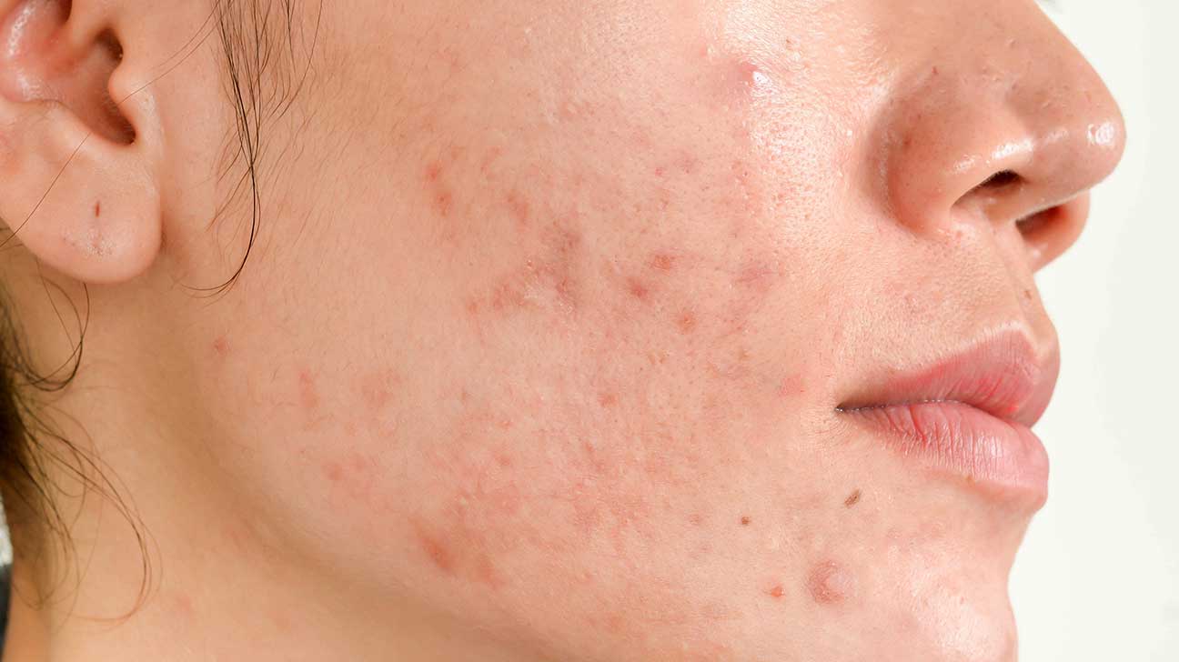 Acne Treatment in Mumbai by Dr Rinky Kapoor at The Esthetic Clinics