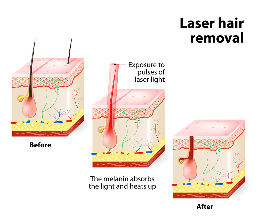 Laser Hair Removal Treatment in India by Dr Rinky Kapoor at The Esthetic Clinics