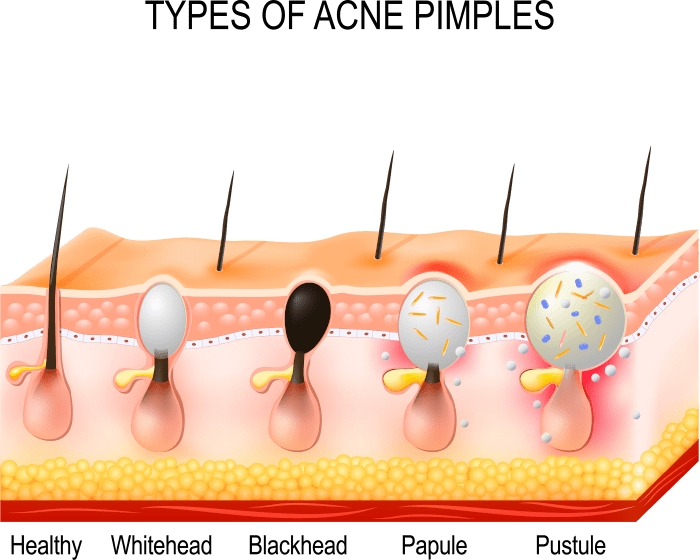 Acne Treatment in Mumbai, India at Affordable Cost by Dr Rinky Kapoor at The Esthetic Clinics