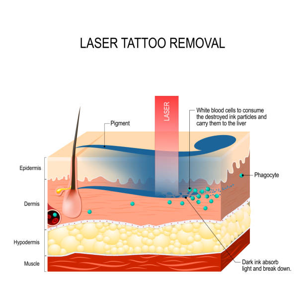 Laser Tattoo Removal Treatment in Mumbai, India at Affordable Cost by Dr Rinky Kapoor at The Esthetic Clinics