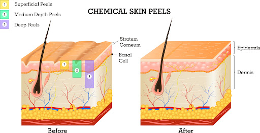 Chemical Peel Treatment in Mumbai, India at Affordable Cost by Dr Rinky Kapoor at The Esthetic Clinics