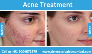 Acne treatment for face pimples before and after results