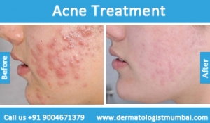Acne treatment for face pimples photos before after