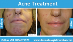 Acne treatment for face pimples before after photos result